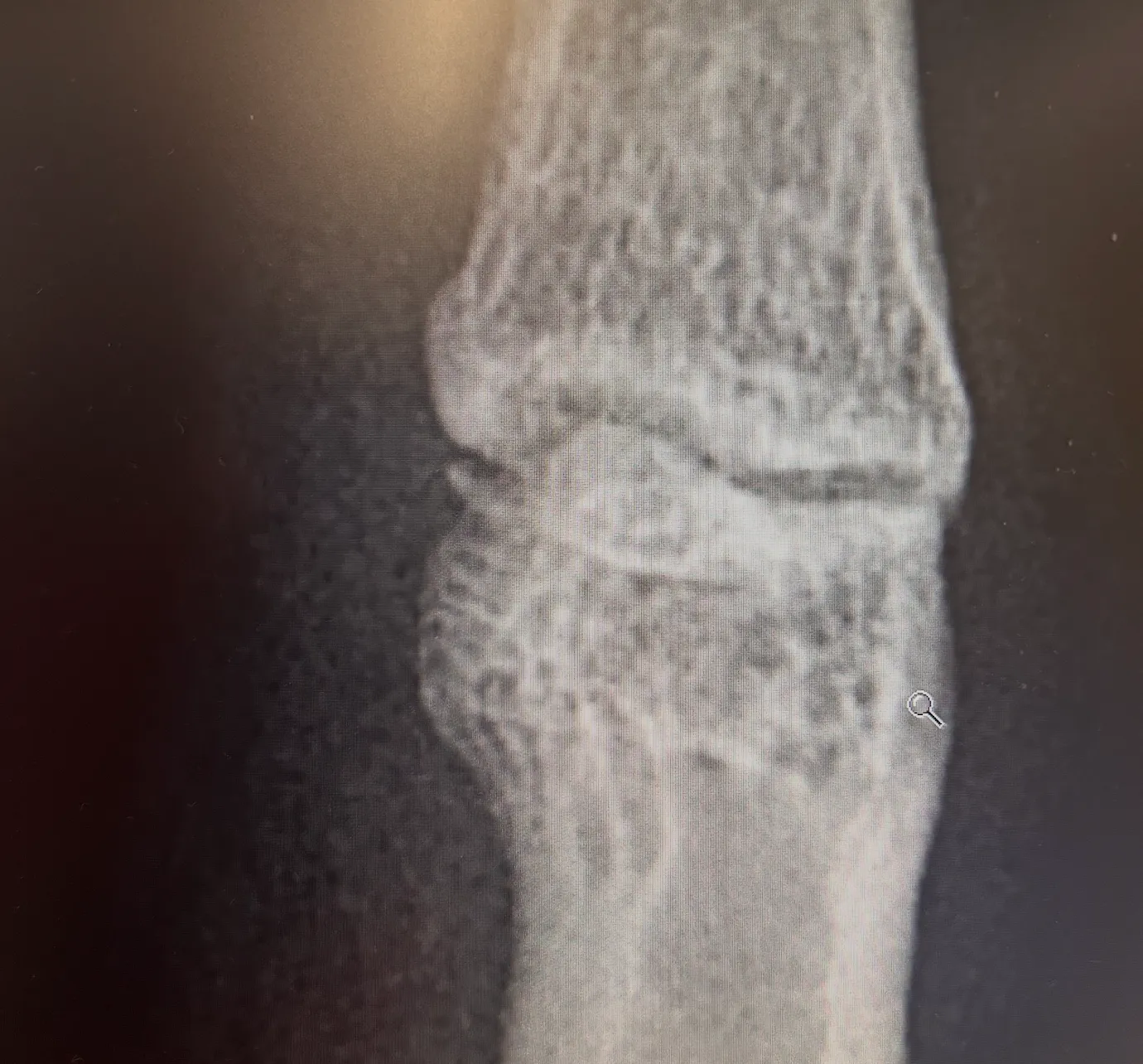 Broken finger